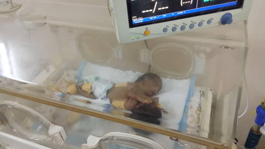 في بادرة إنسانية استثنائية، أعلن الطاهر إبراهيم الخير والي ولاية الجزيرة، صباح السبت، تكفله الكامل بتكاليف عملية فصل التوأم السيامي بمركز جراحة الأطفال القومي بمدني، في خطوة تمنح الطفلين فرصة للحياة الطبيعية.