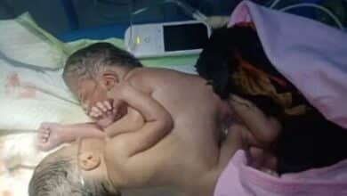 شهد مستوصف العناية بربك  الثلاثاء ولادة نادرة لتوأم سيامي وُلدا ملتصقين من منطقة السرة، حيث يتشاركان في معدة واحدة وكبد واحد، بينما يمتلك كل منهما قلبًا منفصلًا، وأحدهما لا يملك فتحة شرج.