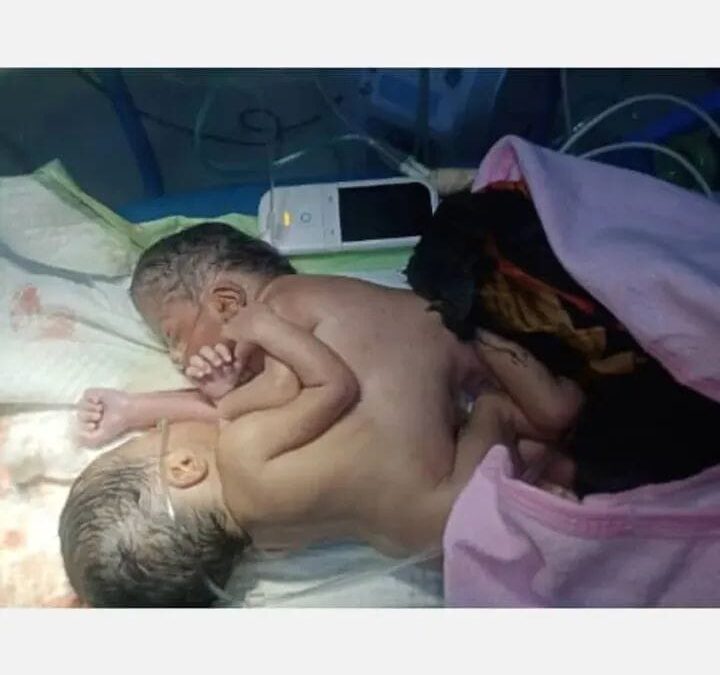 شهد مستوصف العناية بربك  الثلاثاء ولادة نادرة لتوأم سيامي وُلدا ملتصقين من منطقة السرة، حيث يتشاركان في معدة واحدة وكبد واحد، بينما يمتلك كل منهما قلبًا منفصلًا، وأحدهما لا يملك فتحة شرج.